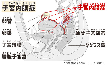Locations where endometriosis is likely to occur - Easy-to-understand Japanese illustrations Locations where endometriosis is likely to occur - Easy-to-understand Japanese illustrations 113468893