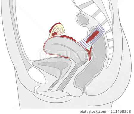 Common areas for endometriosis: Easy-to-understand illustrations 113468898