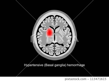 Basal ganglia hemorrhage brain scan illustration Basal ganglia hemorrhage brain scan illustration 113471615