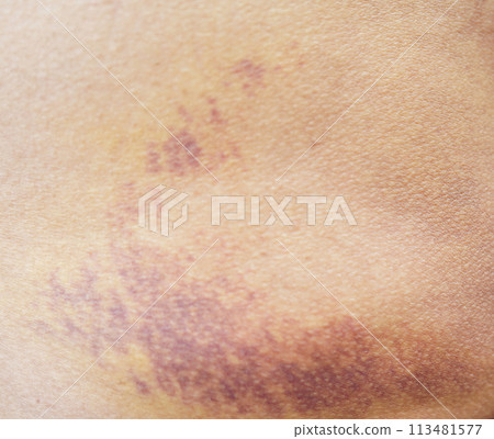 Bruise on the buttock skin injury from accident at home. Bruise on the buttock skin injury from accident at home. 113481577