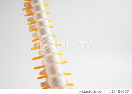 Spinal nerve and bone, Lumbar spine displaced herniated disc fragment, Model for treatment medical in the orthopedic department. Spinal nerve and bone, Lumbar spine displaced herniated disc fragment, Model for treatment medical in the orthopedic department. 113481677