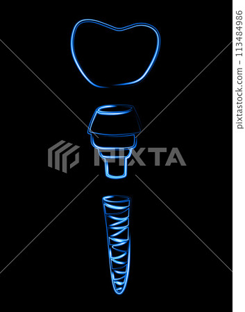 Vector isolated illustration of dental implant with neon effect. 113484986