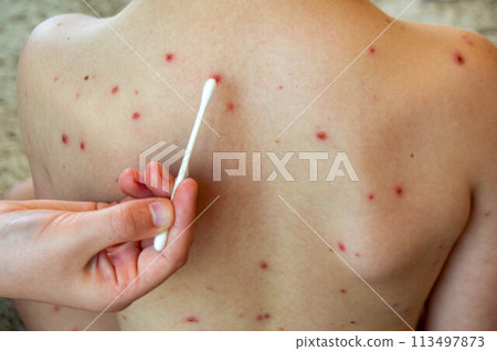 Natural vaccination. Contagious disease. Natural vaccination. Contagious disease. 113497873