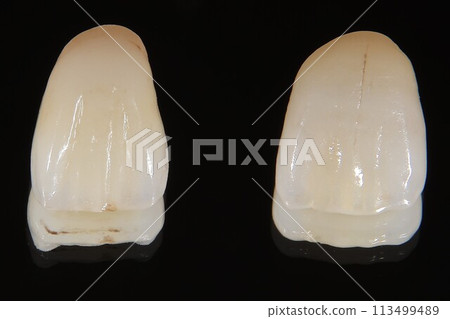 全瓷冠 全瓷冠 113499489