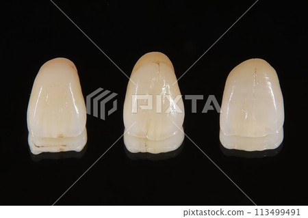 All-ceramic crown 113499491