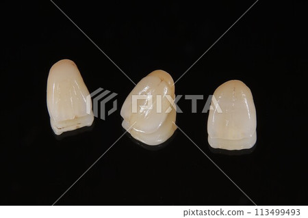 All-ceramic crown All-ceramic crown 113499493