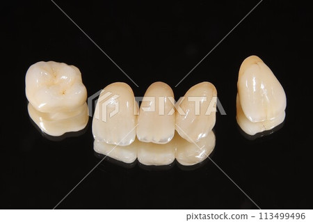 全瓷冠 全瓷冠 113499496