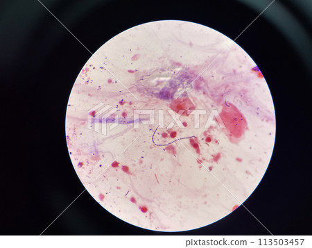 Gram stain.Gram positive cocci in chain. Gram stain.Gram positive cocci in chain. 113503457
