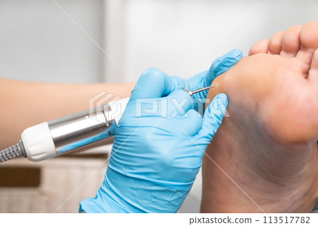 A podologist using electric drill removes a callus from a womans foot at the medical center A podologist using electric drill removes a callus from a womans foot at the medical center 113517782