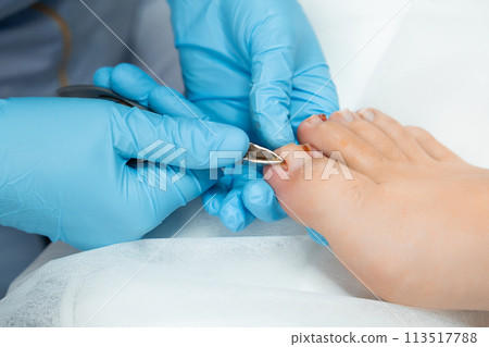 Podologist during the procedure of ingrown nail removal with nippers. Podologist during the procedure of ingrown nail removal with nippers. 113517788