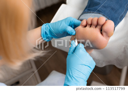 Podologist removing a callus on a womans foot by nippers at the medical center  113517799