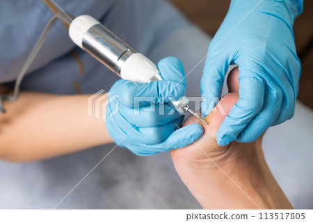 A callus on a womans foot is removed by a podologist using an electric drill at the clinic. A callus on a womans foot is removed by a podologist using an electric drill at the clinic. 113517805