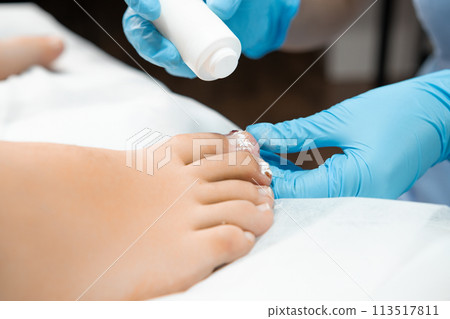 Application of antibiotic powder proves effective in combating toenail ailments caused by fungal or bacterial infections on female toe, such as athletes foot or toenail fungus by podologist 113517811