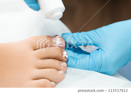 Antibiotic powder is used for treating various fungal or bacterial infections on the toenails by podologist in the clinic 113517812