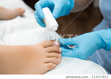 Application of antibiotic powder on toenails by podologist in the clinic.  113517813