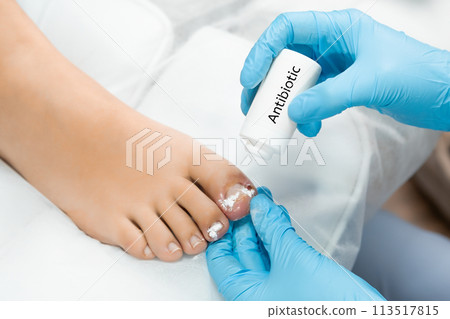 Podologist uses antibiotic after ingrown toenail removal.  113517815
