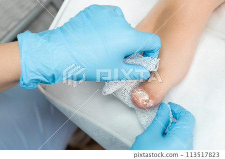 Podologist applies a powdery antiseptic to the toe after removing the nail.  113517823