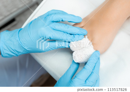 Podologist uses a bandage after applying antiseptic to the toe after removing the nail.  113517826