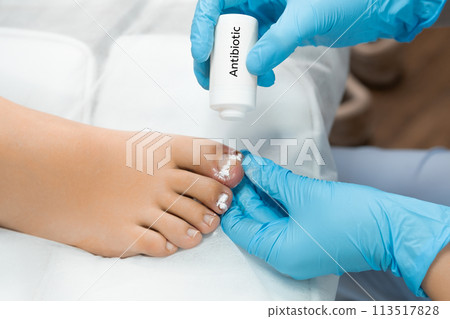 Podologist uses antibiotic powder after removal of ingrown toe nail. Podologist uses antibiotic powder after removal of ingrown toe nail. 113517828