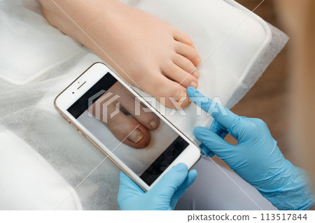 Podologist compares the results after ingrown toenails removal using a photo on a smartphone Podologist compares the results after ingrown toenails removal using a photo on a smartphone 113517844