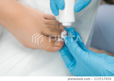 Following nail removal, the podologist dusts an antiseptic powder onto the toe area Following nail removal, the podologist dusts an antiseptic powder onto the toe area 113517850