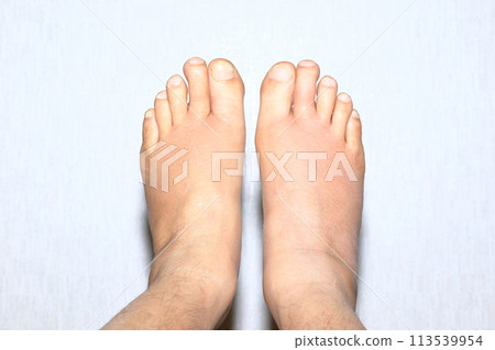 痛風發作一週後腫脹（左腳掌、右腳掌、手指） 113539954