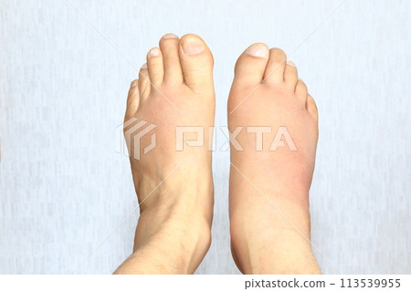 痛風發作第三天腫脹(左腳掌、右腳掌、手指) 痛風發作第三天腫脹(左腳掌、右腳掌、手指) 113539955