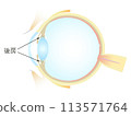 Vertical section of the eye Posterior chamber 113571764