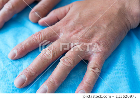 Treatment of dermatitis and psoriasis. Close-up of hands with very poor skin condition, cracked skin on hands. Treatment of dermatitis and psoriasis. Close-up of hands with very poor skin condition, cracked skin on hands. 113620975