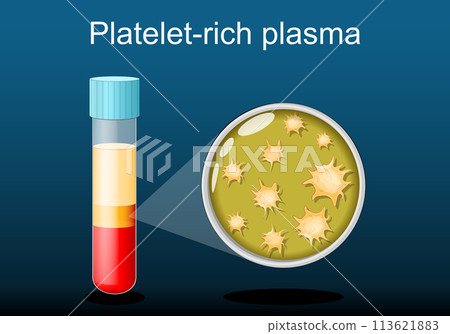 PRP. test tube with blood and platelet-rich plasma. PRP. test tube with blood and platelet-rich plasma. 113621883