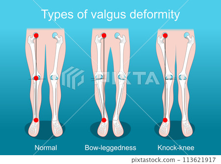 valgus deformities. Knee deformity. Corrective surgery valgus deformities. Knee deformity. Corrective surgery 113621917