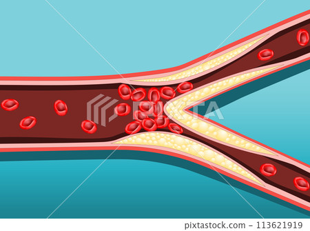 Atherosclerosis artery 113621919