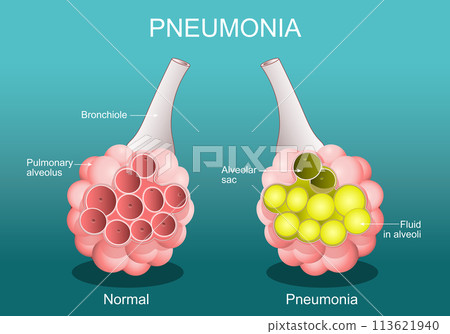 Pneumonia. Cross section of normal alveolus, and Alveoli are filled with fluids. 113621940