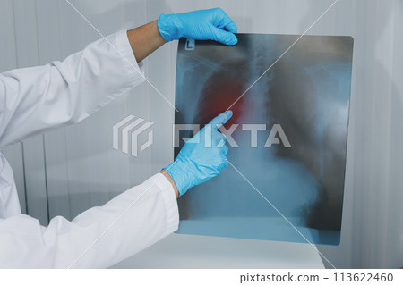 Doctor explaining lungs x-ray film to patiant in the medical office. The film shows symptom of virus or cancer infect patient lung and respiratory organ. Doctor explaining lungs x-ray film to patiant in the medical office. The film shows symptom of virus or cancer infect patient lung and respiratory organ. 113622460