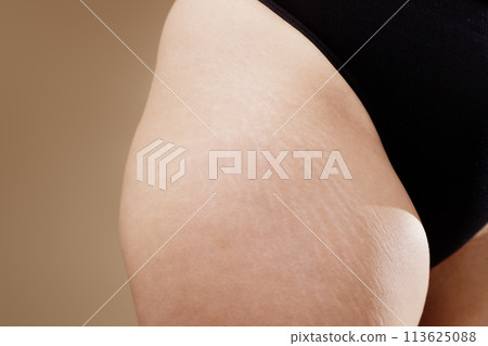 Stretch marks on female legs. A woman's fat Stretch marks on female legs. A woman's fat 113625088