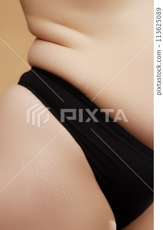Closeup Stretch marks on female legs. A woman's 113625089