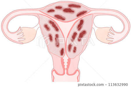 子宮肌腺症-易於理解的插圖 子宮肌腺症-易於理解的插圖 113632990