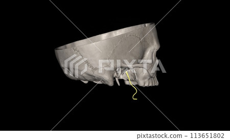 The lingual nerve carries sensory innervation from the anterior two-thirds of the tongue 113651802