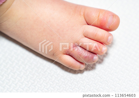 A photo of a toddler's feet with chilblains. 113654603