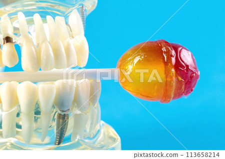 Candy on a stick in a tooth jaw mockup on a blue background. Concept of the effect of candies and sweets on the oral cavity and tooth enamel. Tooth destruction by sweet bacteria. Pulpitis and caries, 113658214