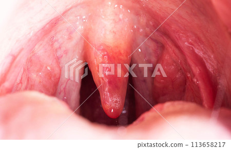 Red, inflamed and swollen uvula in the throat. Treatment of uvulitis due to bacteria and streptococcal viruses. Otolaryngology, macro. Allergy 113658217