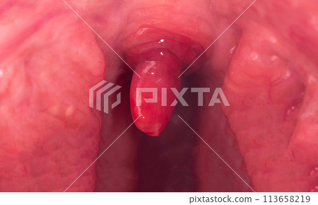 Inflammation of the uvula in the oral cavity due to infection and virus. Treatment of the disease is uvulitis. Red throat due to illness, close-up. Allergy Inflammation of the uvula in the oral cavity due to infection and virus. Treatment of the disease is uvulitis. Red throat due to illness, close-up. Allergy 113658219