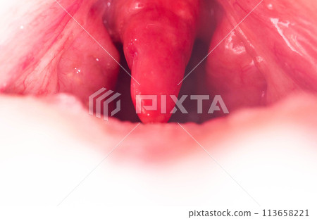Long uvula with inflammation of infections and viruses. Treatment of uvulitis in children and adults. Sore throat, sore throat, macro Long uvula with inflammation of infections and viruses. Treatment of uvulitis in children and adults. Sore throat, sore throat, macro 113658221