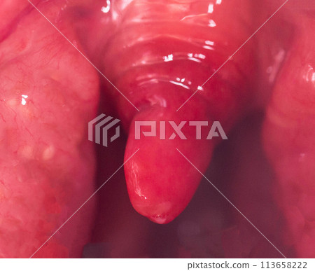 Long uvula with inflammation of infections and viruses. Treatment of uvulitis in children and adults. Sore throat, sore throat, macro. Allergy 113658222