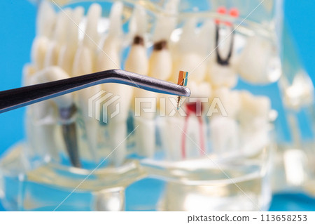 A dental metal pin in tweezers against the background of a medical model of a dental jaw. The concept of installing a dental crown on a post in orthodontics, macro. A dental metal pin in tweezers against the background of a medical model of a dental jaw. The concept of installing a dental crown on a post in orthodontics, macro. 113658253