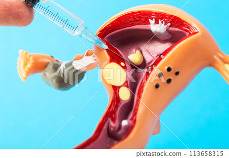 Injection into a medical mockup of the female reproductive system on a blue background. The concept of intimate plastic surgery and plasma lifting. Hylauronic acid injections, G point enlargement, 113658315