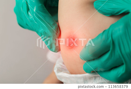 Doctor's hands in medical gloves examine the umbilical ring of a newborn baby. Treatment of umbilical hernia in children, close-up 113658379