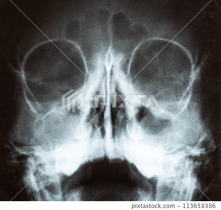 X-ray image of the skull of a child with purulent sinusitis, close-up. Treatment of inflamed sinuses, purulent secretion X-ray image of the skull of a child with purulent sinusitis, close-up. Treatment of inflamed sinuses, purulent secretion 113658386