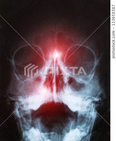 X-ray of sinusitis in a child. Inflammation of the nasal sinuses with purulent sinusitis, close-up X-ray of sinusitis in a child. Inflammation of the nasal sinuses with purulent sinusitis, close-up 113658387
