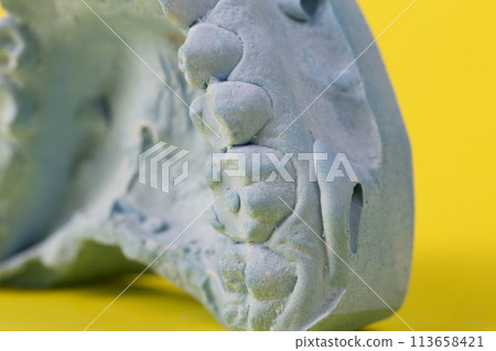 Blue plaster impression of a patient's dental jaw with crooked teeth and malocclusions on a yellow background. Manufacturing of bridges, crowns of various types, macro, arrangement of teeth Blue plaster impression of a patient's dental jaw with crooked teeth and malocclusions on a yellow background. Manufacturing of bridges, crowns of various types, macro, arrangement of teeth 113658421